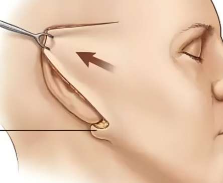 小切口拉皮手術恢復圖如何？看看詳細恢復情況一覽